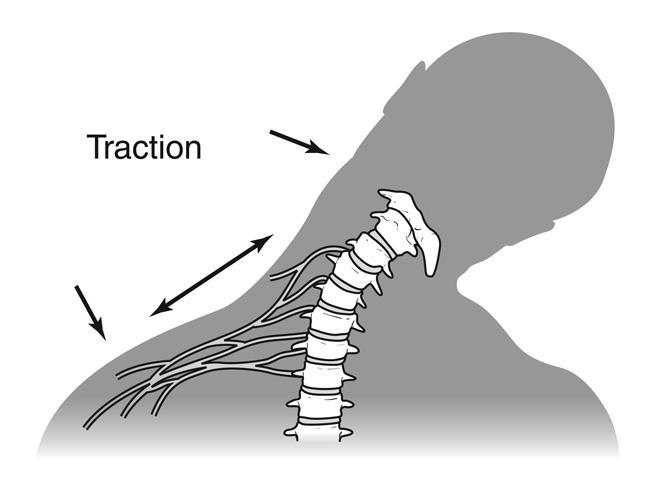 Cervical burners