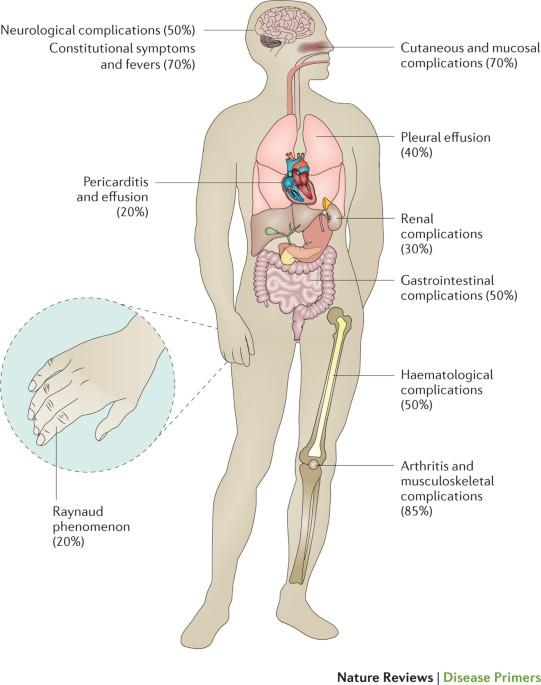 Systemic Lupus Erythematosus