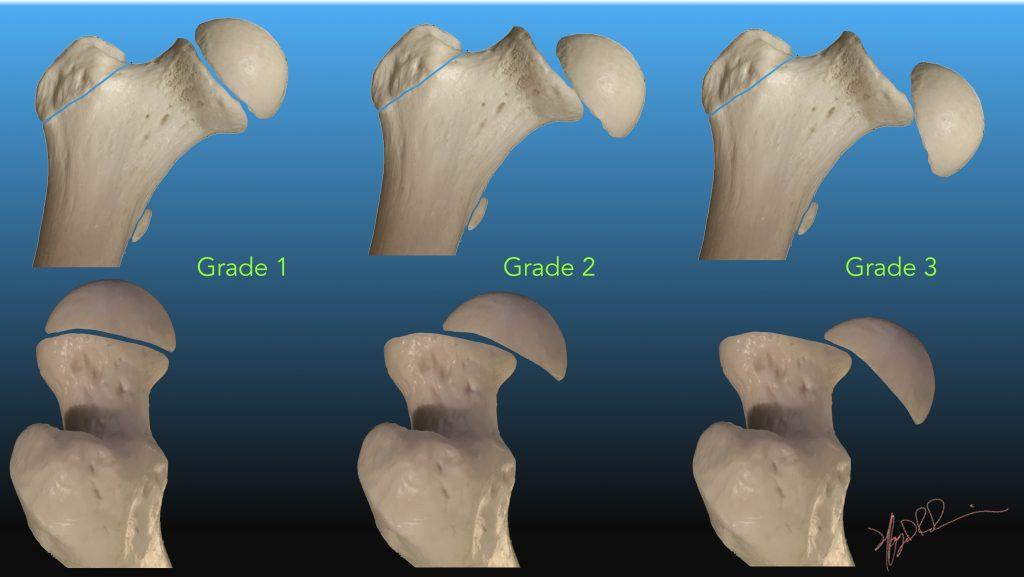 slipped capital femoral epiphysis