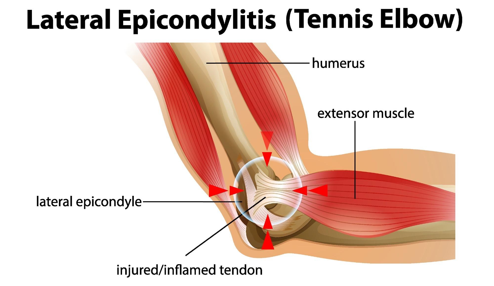 tennis elbow