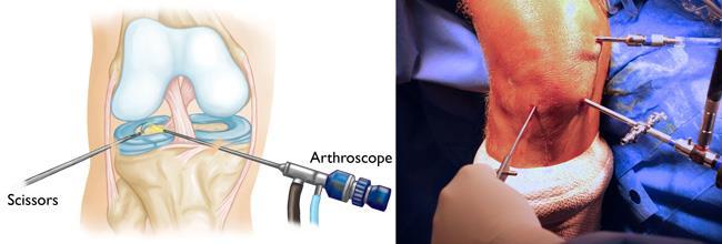 Knee​ arthroscopy