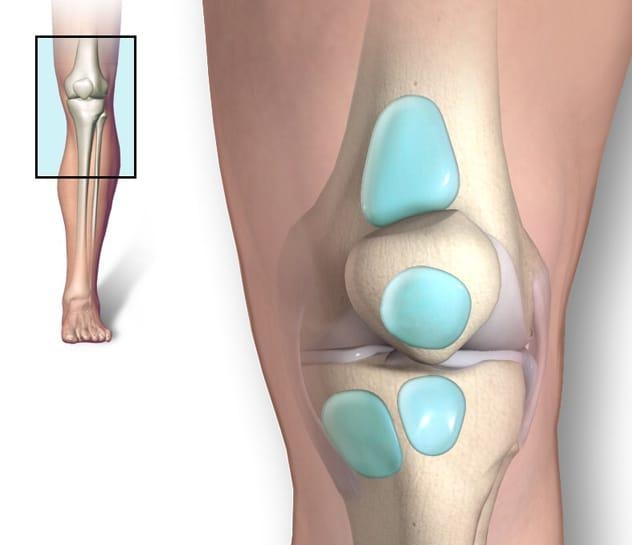 Knee Bursitis