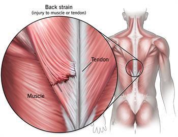 Back Muscle Strain