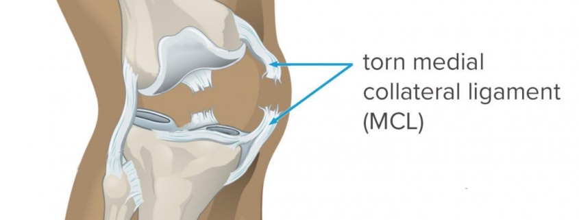 Collateral Ligament Injuries