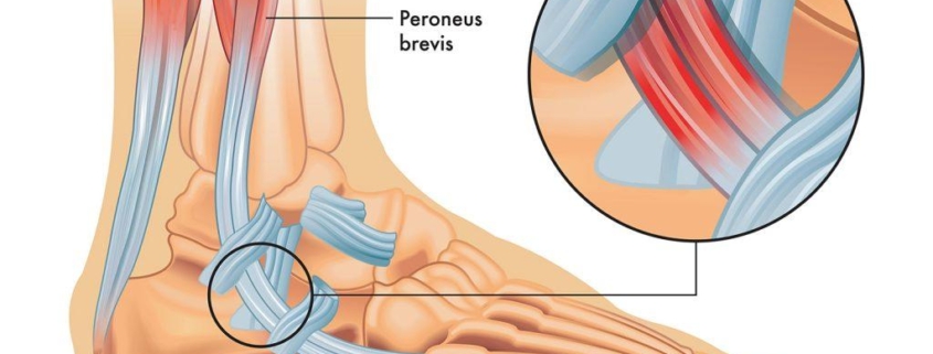 Peroneal Tendon