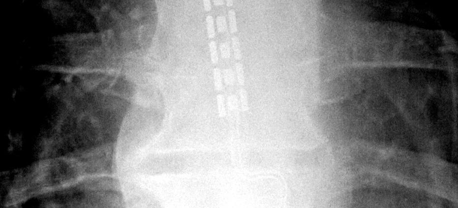 Spinal Cord Stimulators