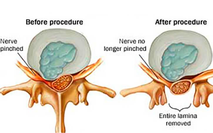 lumbar‍ laminectomy