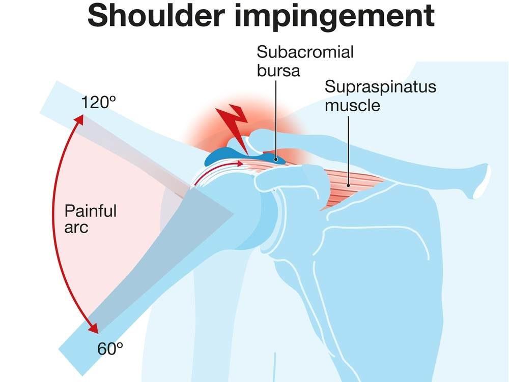 impingement syndrome