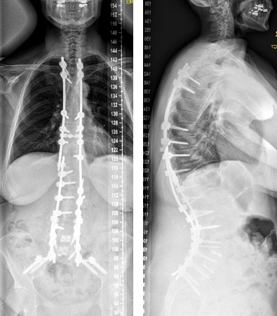 adult‌ degenerative scoliosis