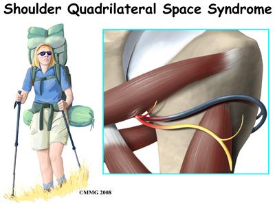 quadrilateral space syndrome