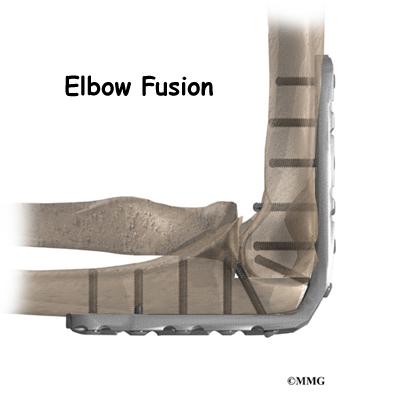 elbow fusion