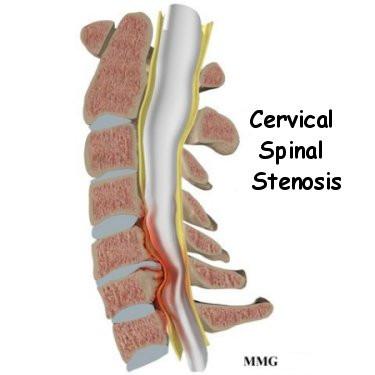 cervical spinal stenosis