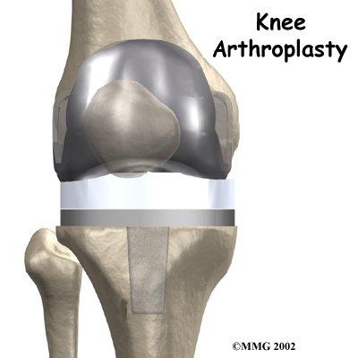 artificial knee joint replacement