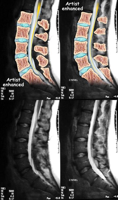 spondyloarthropathies