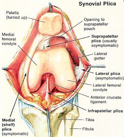 Plica Syndrome