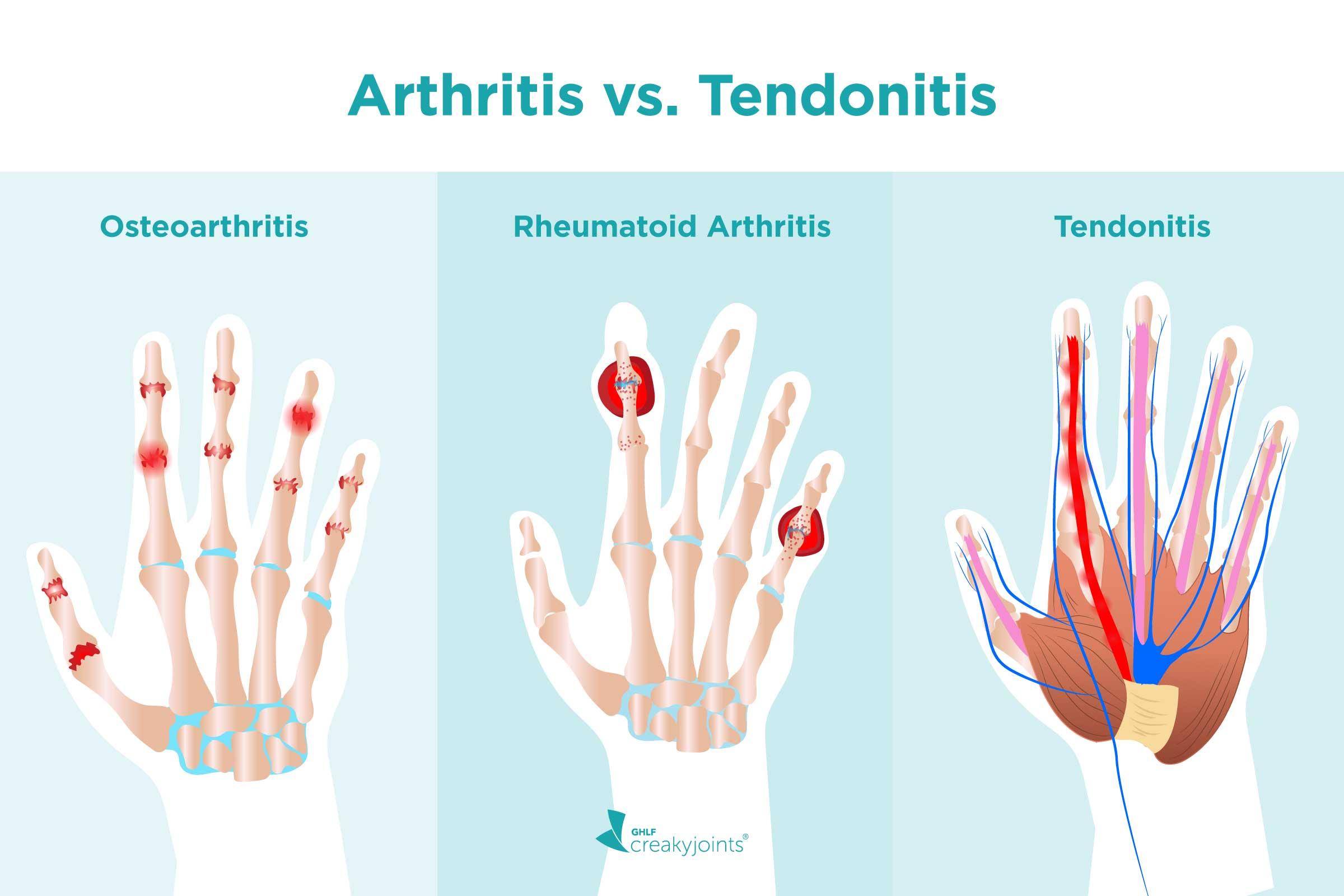 tendonitis