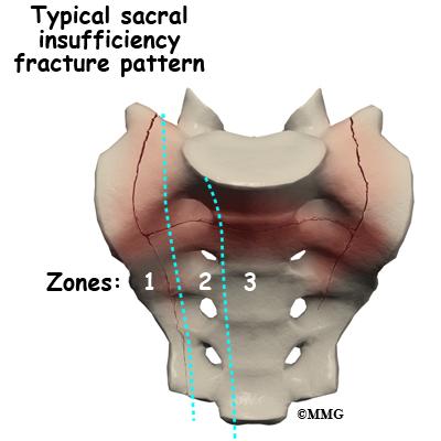 sacral⁣ insufficiency fractures