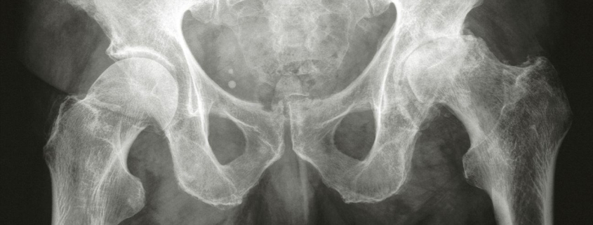 Hip Arthritis