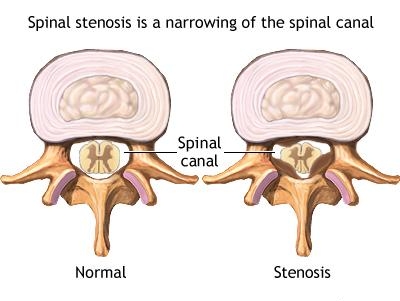 Spinal Stenosis