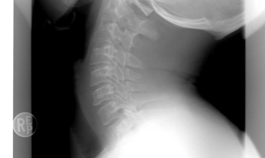 Posterior Cervical Fusion