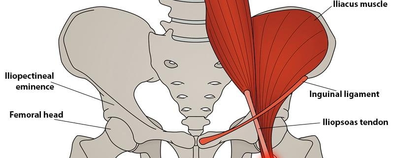 Hip Tendinitis