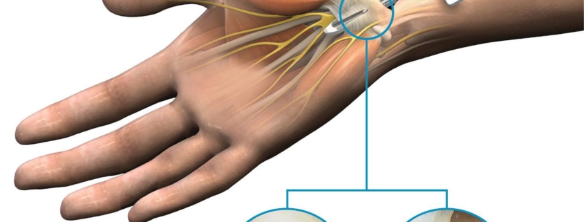 Endoscopic Carpal Tunnel Release