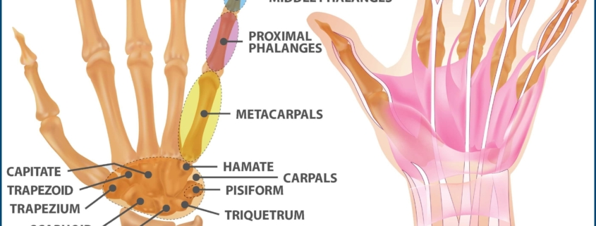 Hand Arthritis