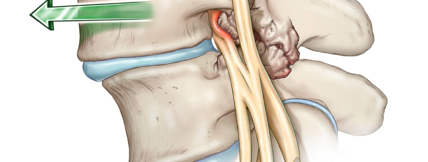 Lumbar Spondylolisthesis