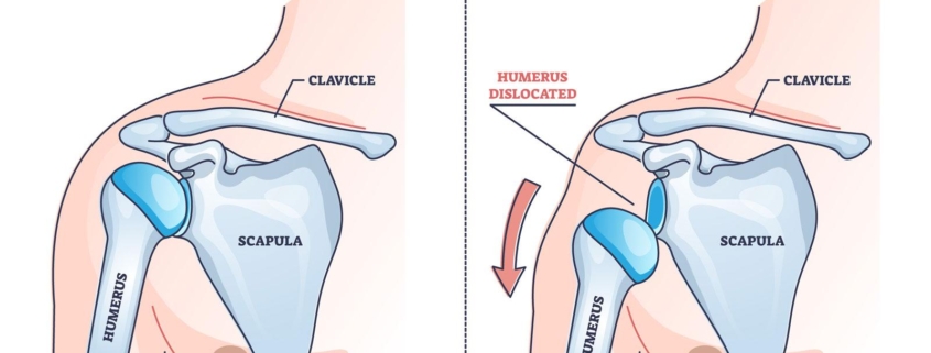 Shoulder Dislocations