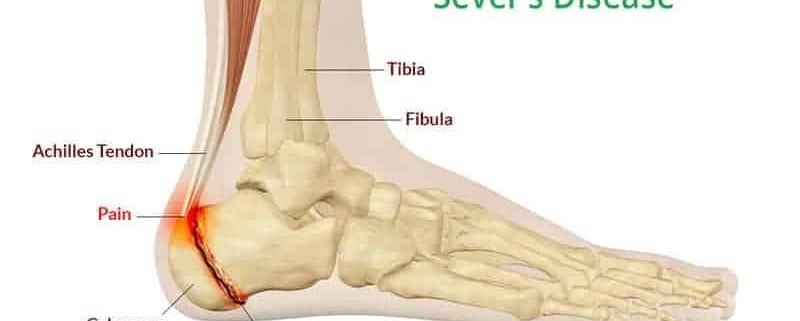 Sever’s Syndrome