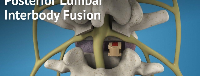 Posterior Lumbar Interbody Fusion