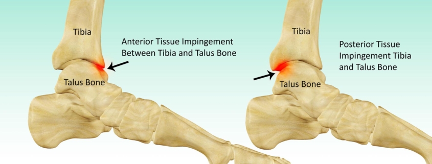 Ankle Impingement