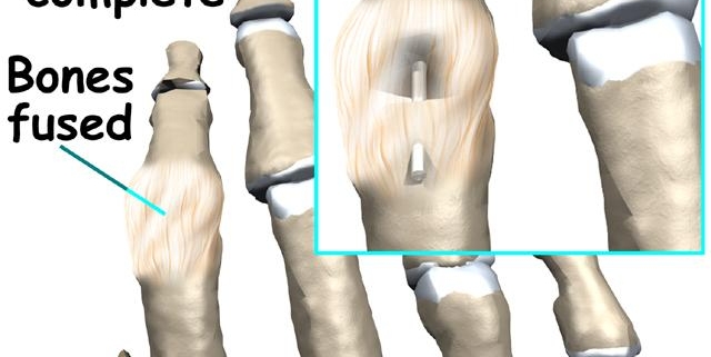 Finger Fusion Surgery