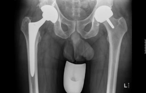 Hip Resurfacing Arthroplasty