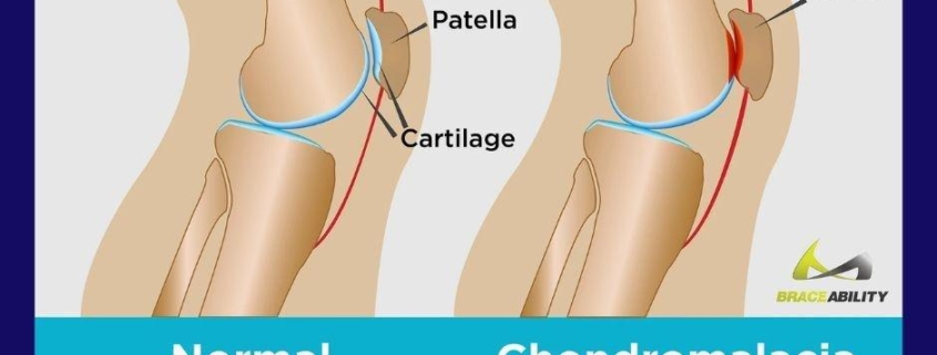 Chondromalacia Patella