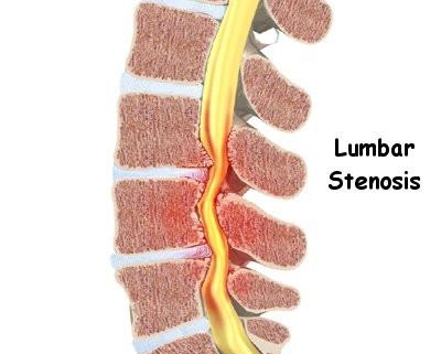 Lumbar Spinal Stenosis