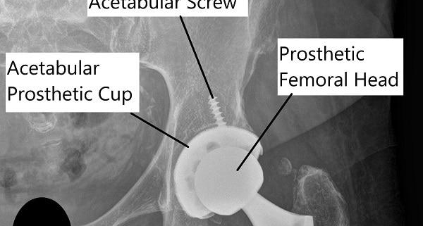 Artificial Hip Dislocation Precautions