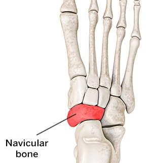 Accessory Navicular Problems