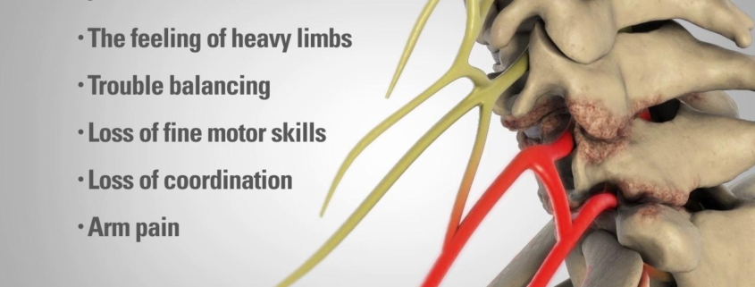 Cervical Laminectomy