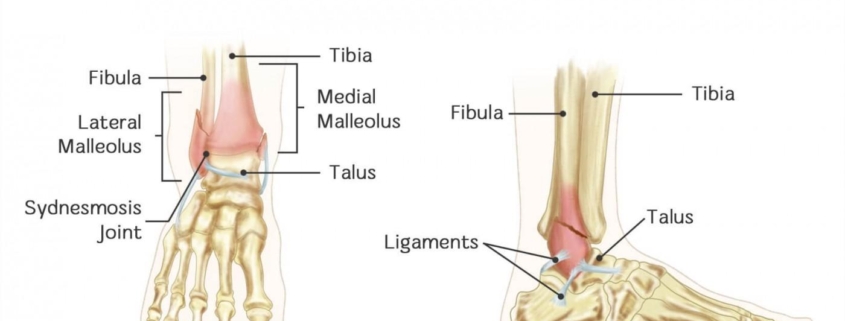 Ankle Fractures