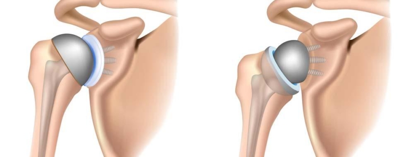 Reverse Shoulder Arthroplasty