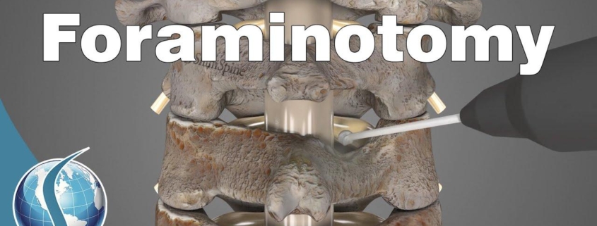 Cervical Foraminotomy