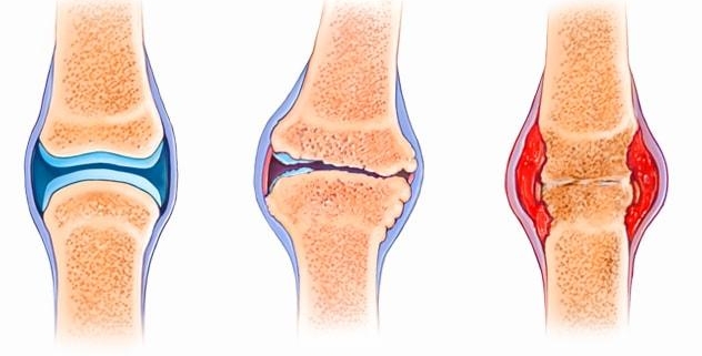 Osteoarthritis