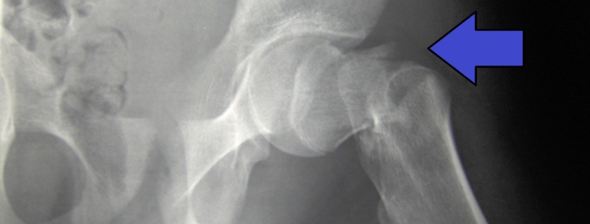 Hip Fracture