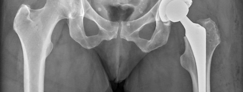 Revision Arthroplasty of the Hip