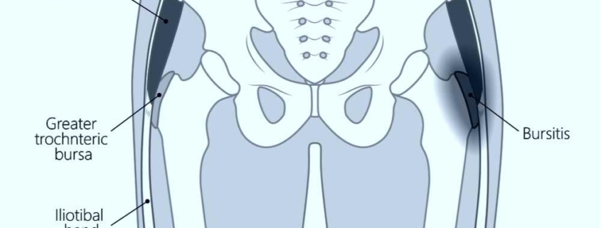 Trochanteric Bursitis of the Hip