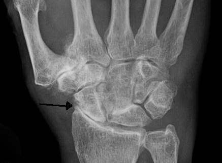 Wrist Joint Osteoarthritis