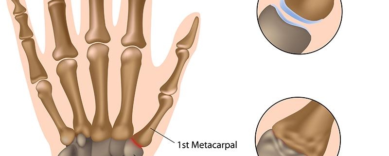 Thumb Arthritis