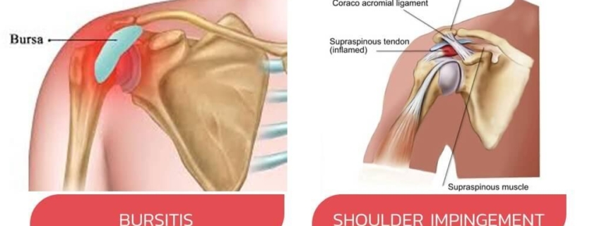 Shoulder Bursitis