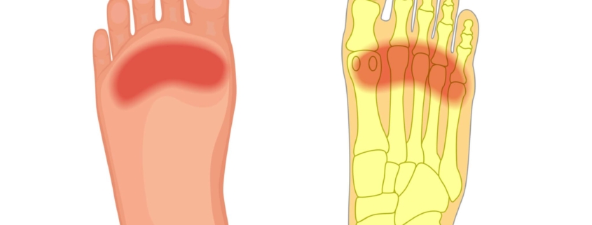 Metatarsalgia